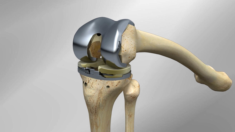 Vanguard® ID Total Knee Surgical Technique Animation